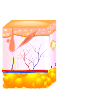 Laser hair removal treatment - heat weakening hair follicle to slow regrowth and leave skin smooth