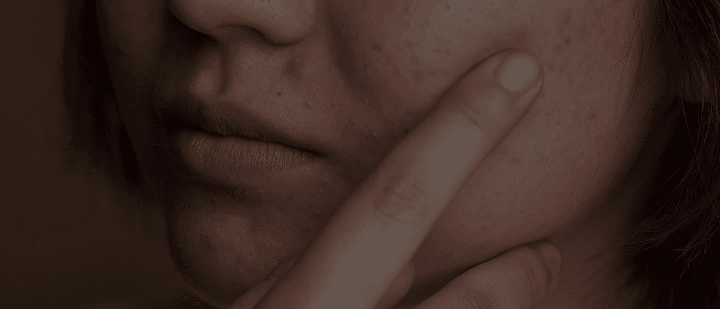 acne-treatment-banner