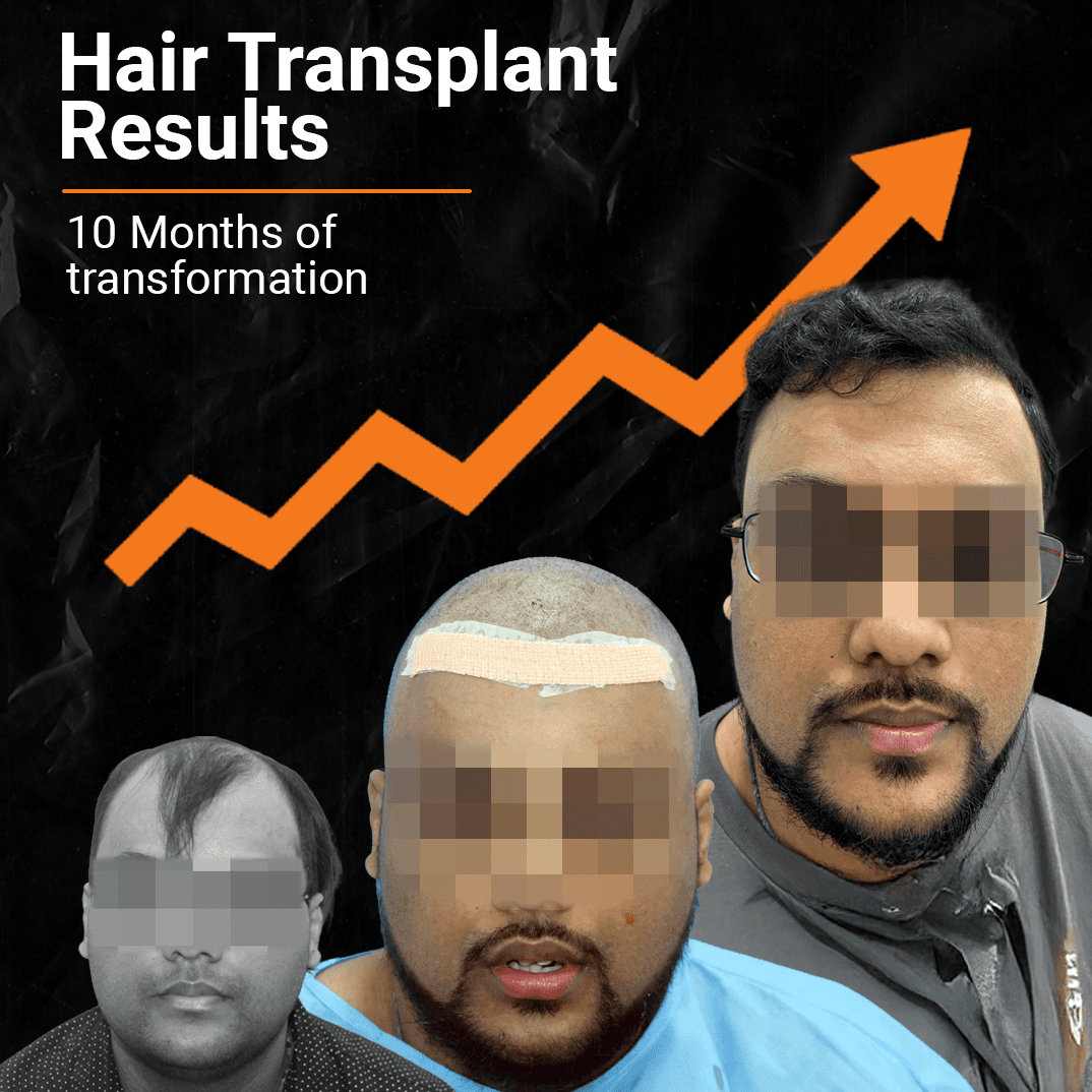 hair transplant cost chandigarh