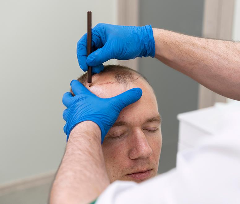 Hair Transplant